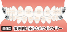 審美的に優れたホワイトワイヤー